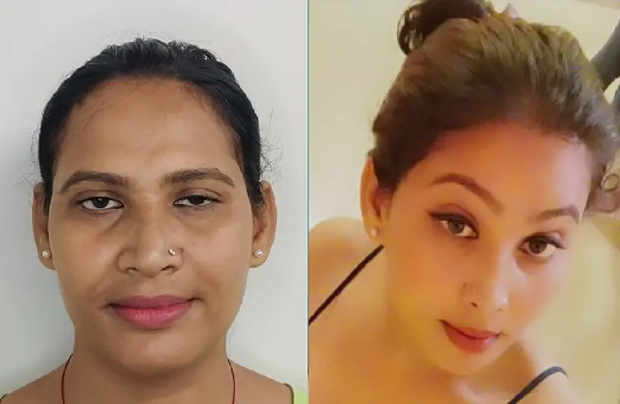 Gallery facial feminization before result